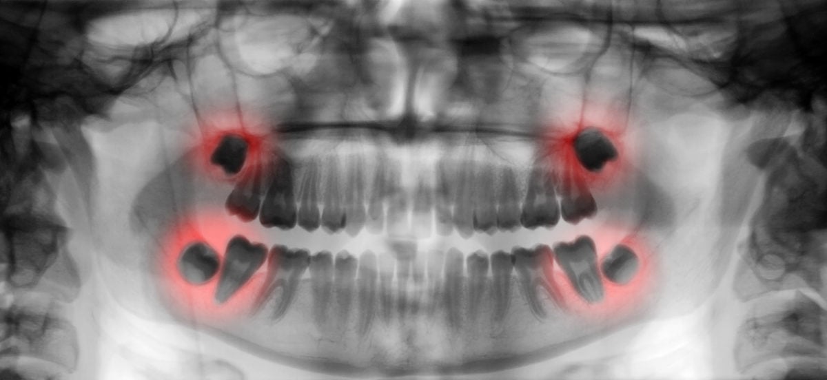 An x-ray image of the mouth with red highlights showing where a wisdom tooth infection could occur