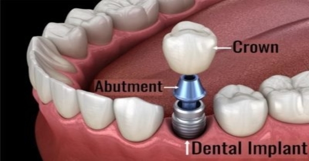 Wisdom Teeth History