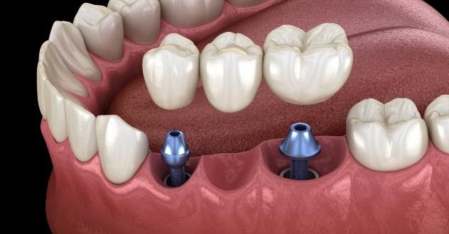 Implant Bridge