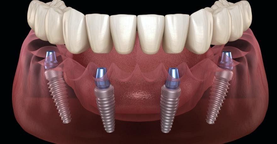 Fixed Implant Denture