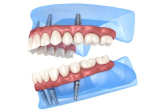 Full Mouth Dental Implants animation