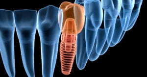 Dental implant animated photo