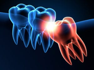 Wisdom teeth animated photo