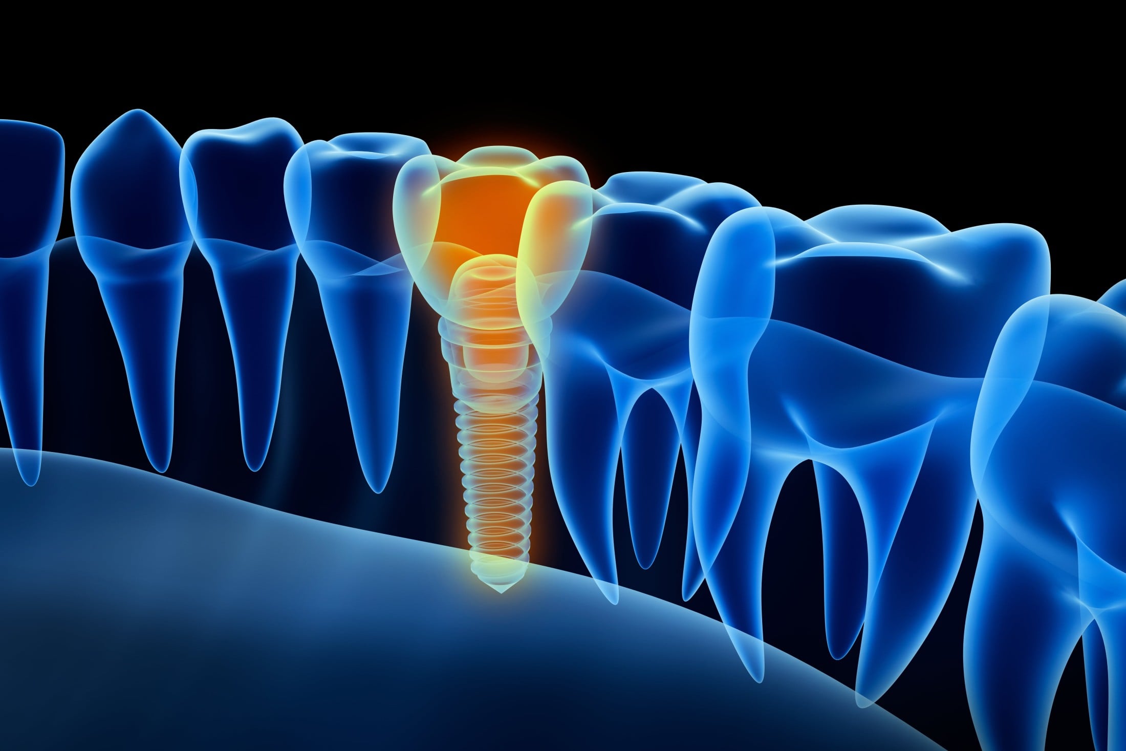 Dental Implant Illustration