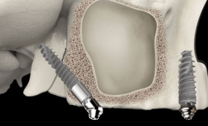 An illustration of Pterygoid Implants