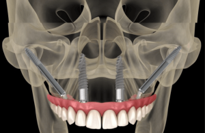 An illustration of Zygomatic Implants